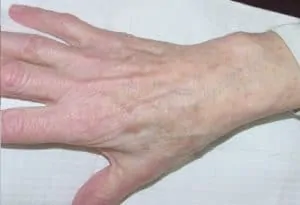 hand after tissue removal