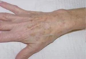 hand before tissue removal