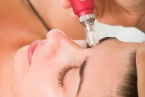 Woman getting micro needling treatment
